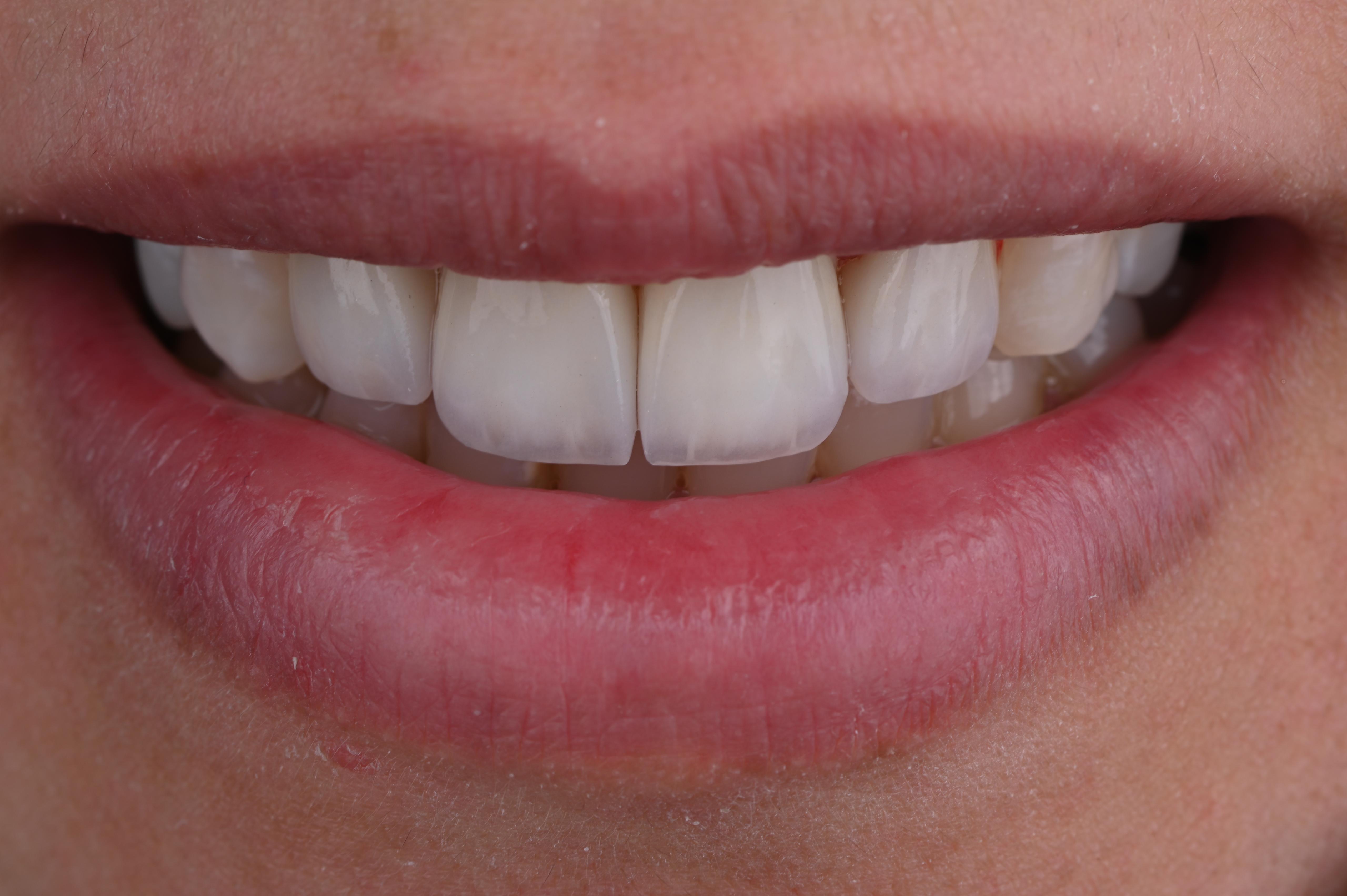 نتيجة جمالية طبيعية - قبل