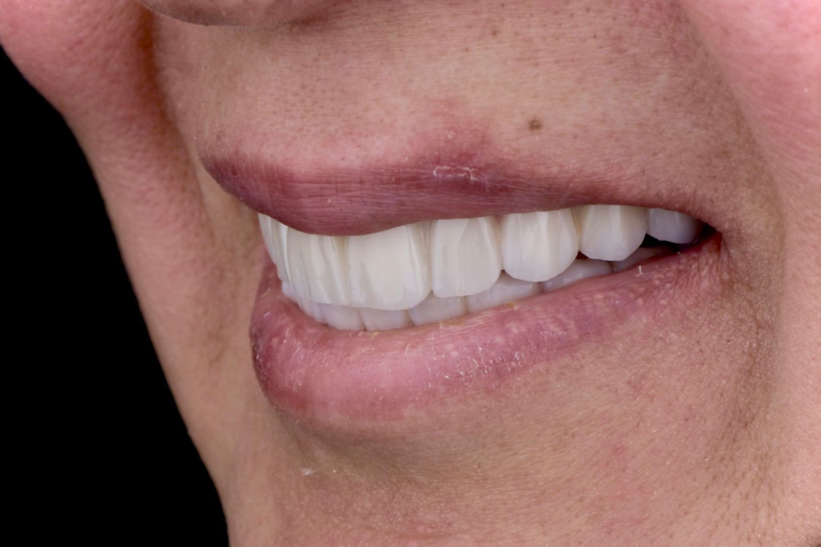 إعادة تأهيل كاملة للفم - بعد